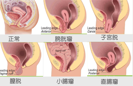 骨盤臓器脱_参考画像