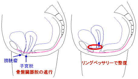 リングペッサリーの使用方法参考画像